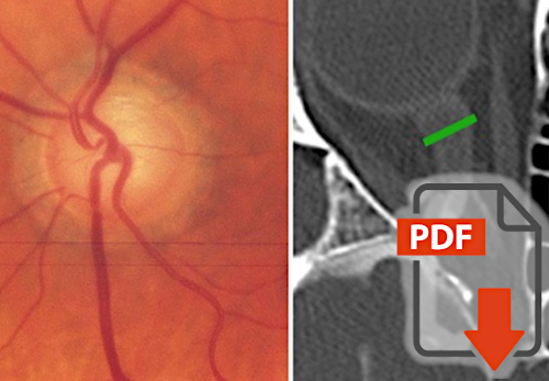 Optic nerve sheath diameter in normal-tension glaucoma patients