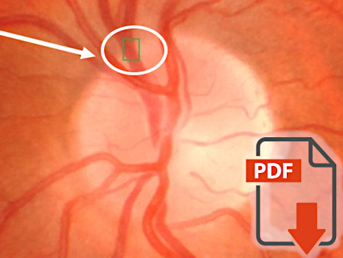 The effect of nifedipine on retinal venous pressure of glaucoma patients with the Flammer-Syndrome