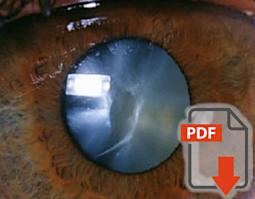 Relationship cataract density and visual field damage